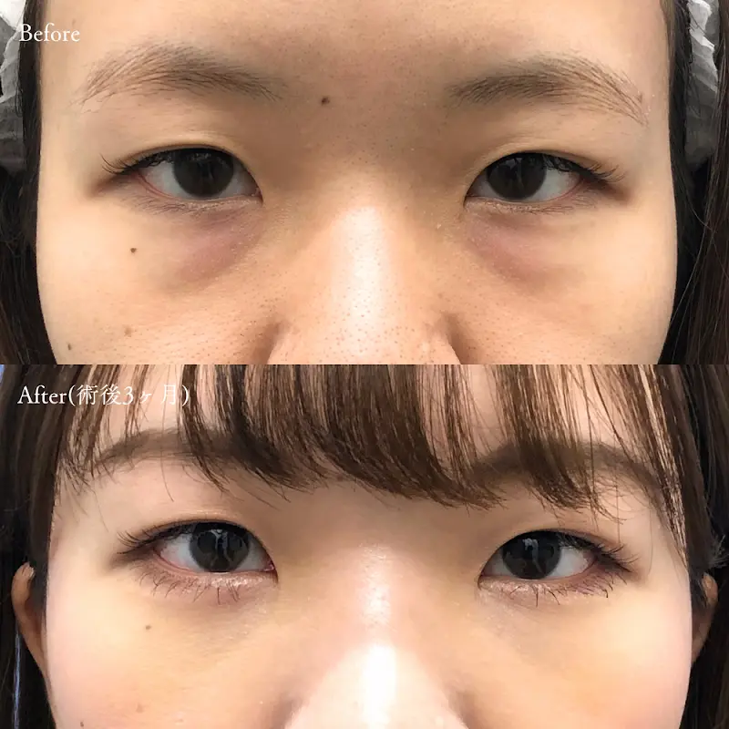 経結膜脱脂術の症例写真