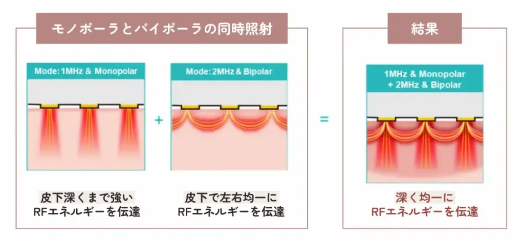 モノポーラとパイポーラの同時照射と結果