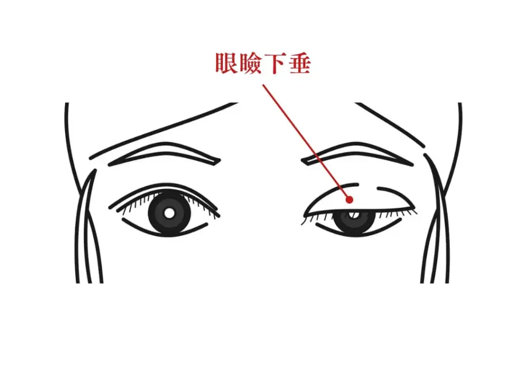 眼瞼下垂イメージ画像