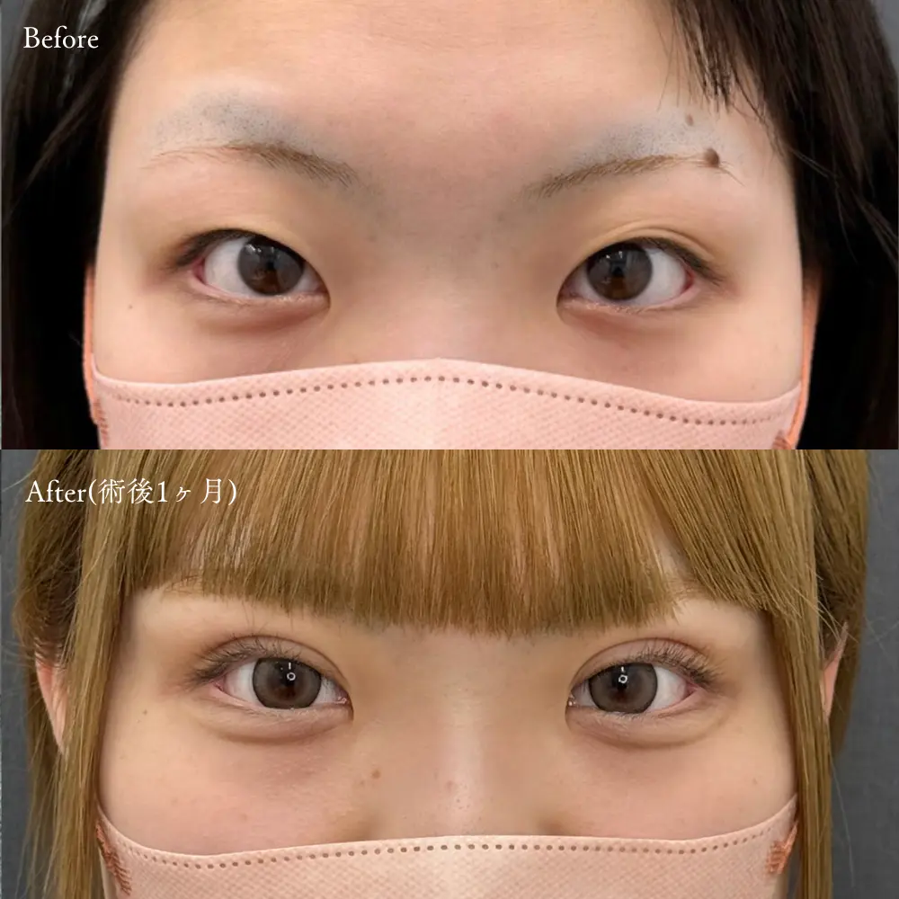 二重埋没法・瞼の脂肪取りの症例写真