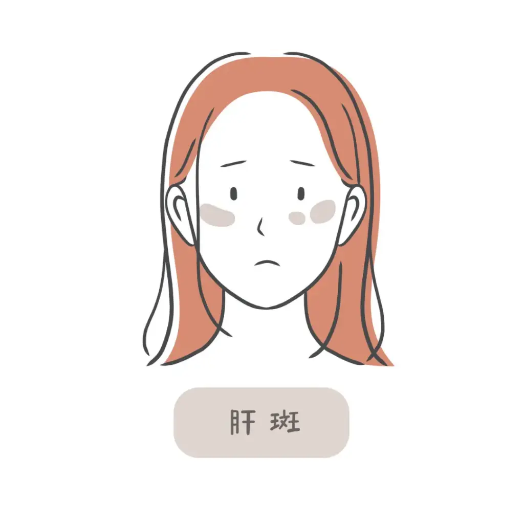 肝斑(かんぱん)