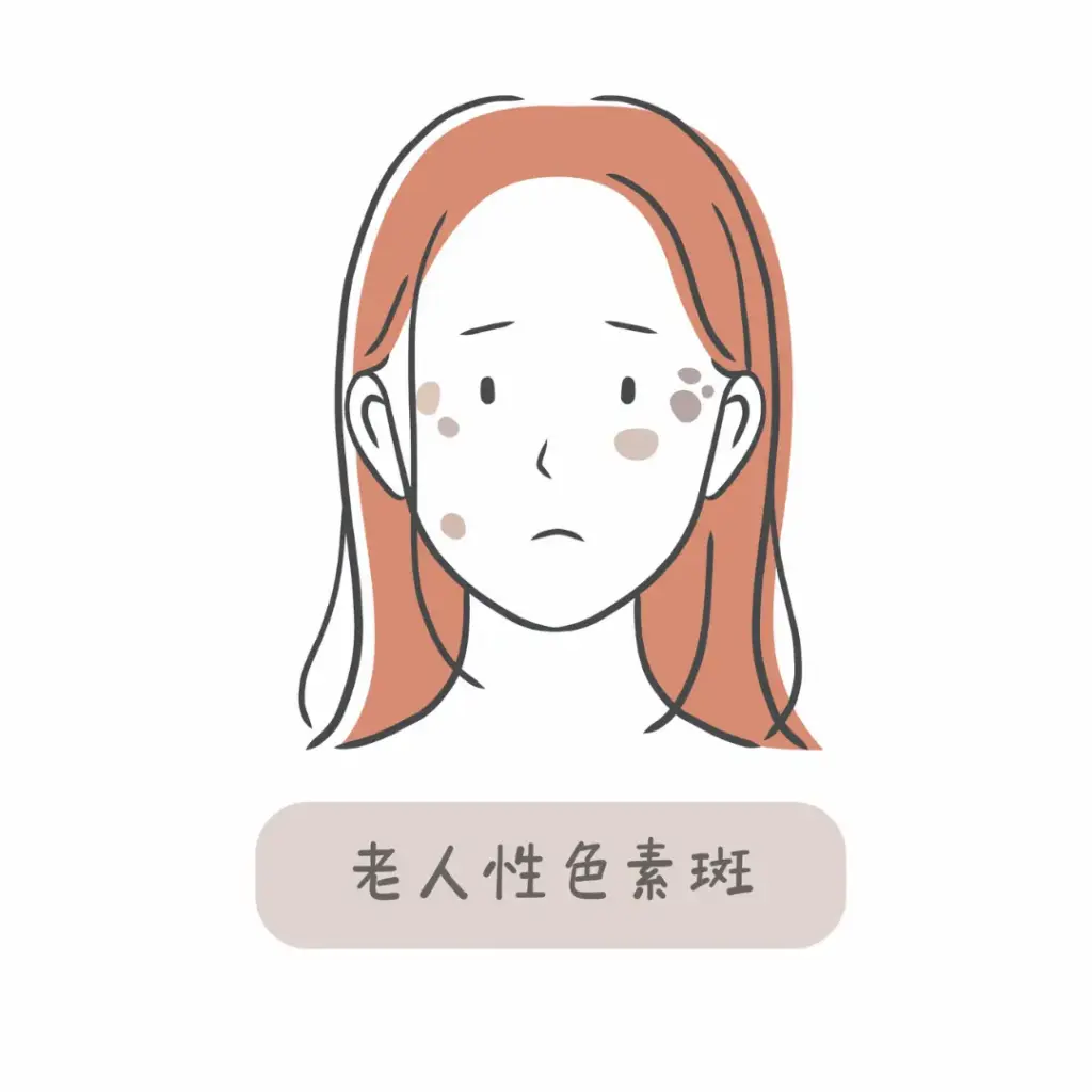 老人性色素斑