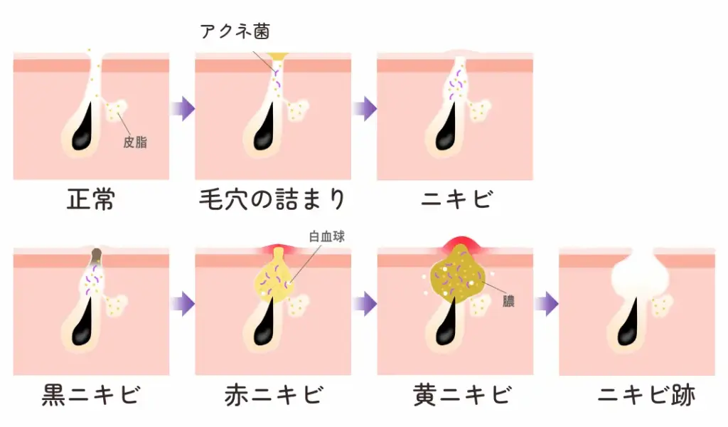 ニキビ・ニキビ跡の改善