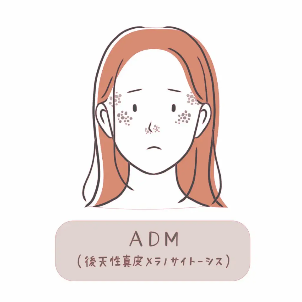 後天性真皮メラノサイトーシス(ADM)