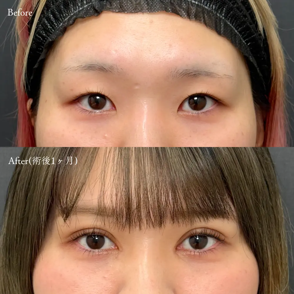 目頭切開・瞼の脂肪取り・二重埋没法の症例写真