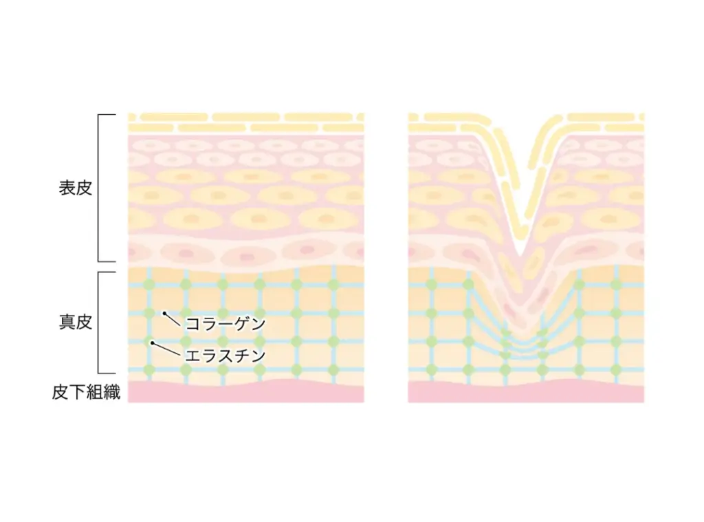 表皮と真皮
