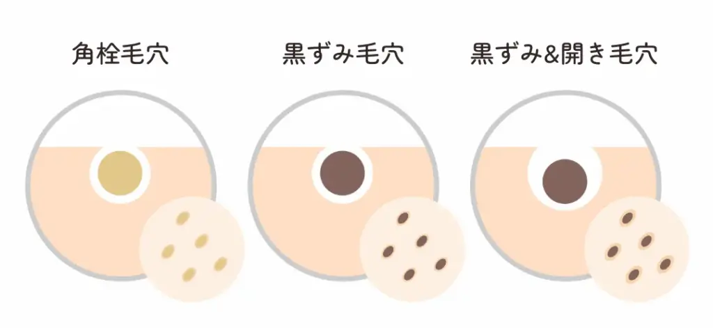 毛穴の開き・黒ずみの改善