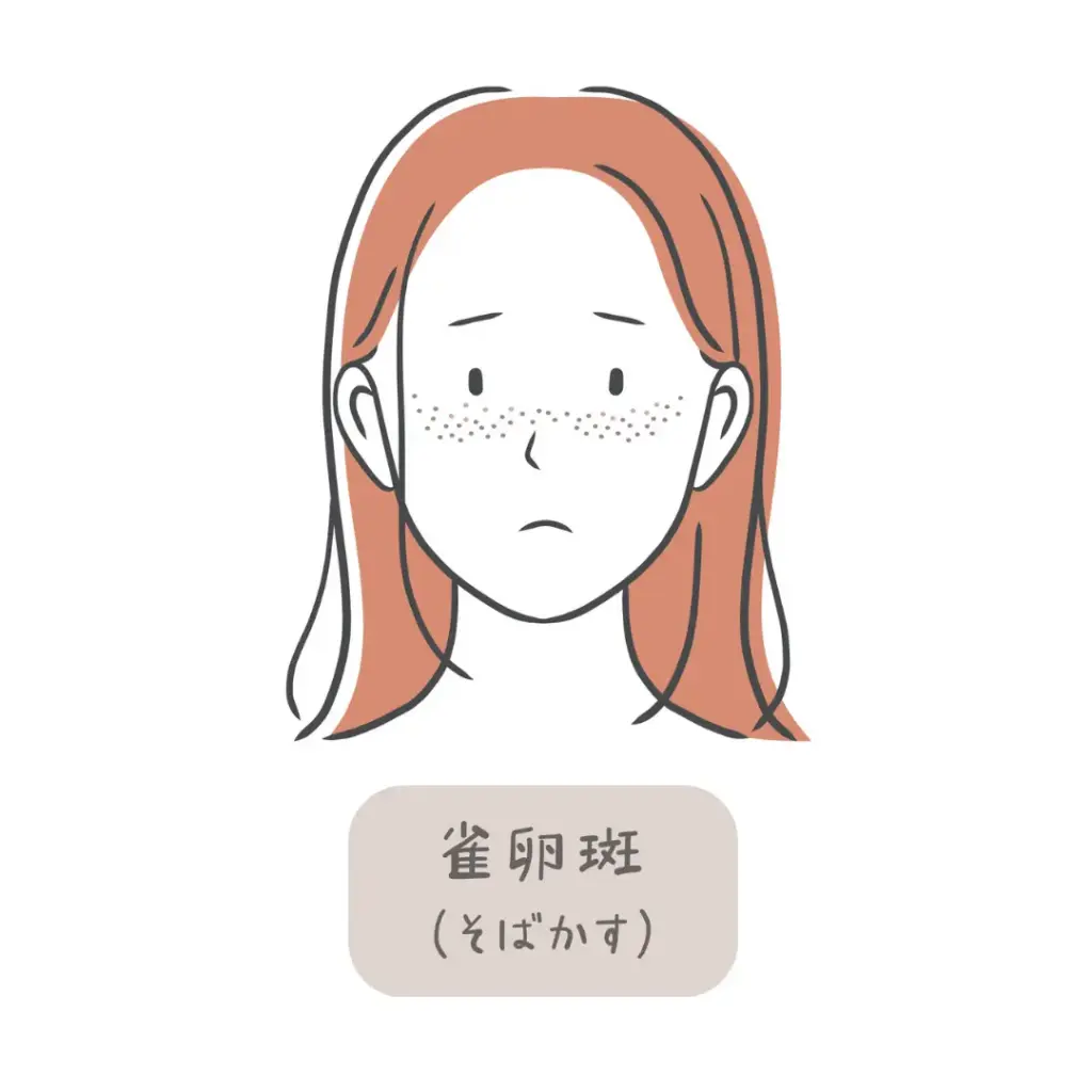そばかす(雀卵斑)