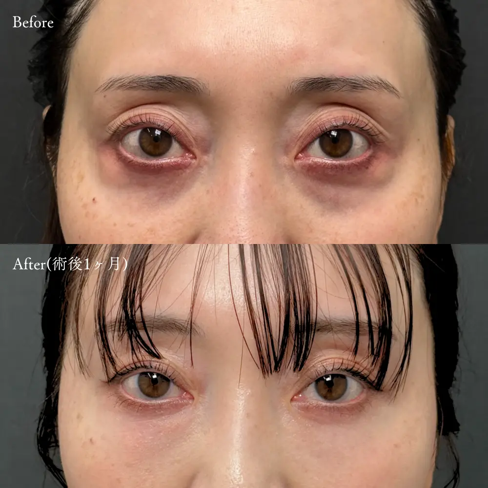 経結膜脱脂術と目の下の脂肪注入の症例写真