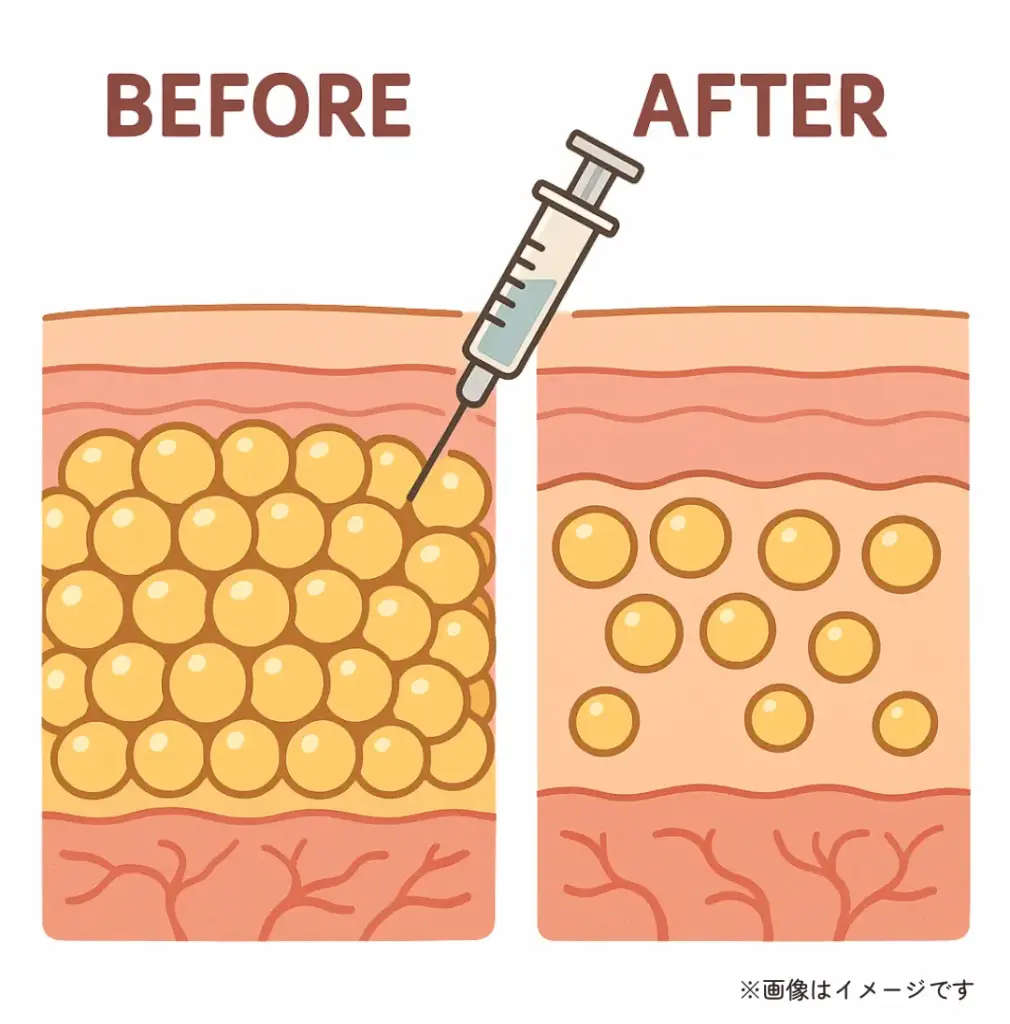 脂肪溶解注射における脂肪細胞の減り方のイメージ