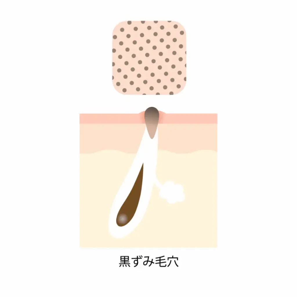 黒ずみ毛穴