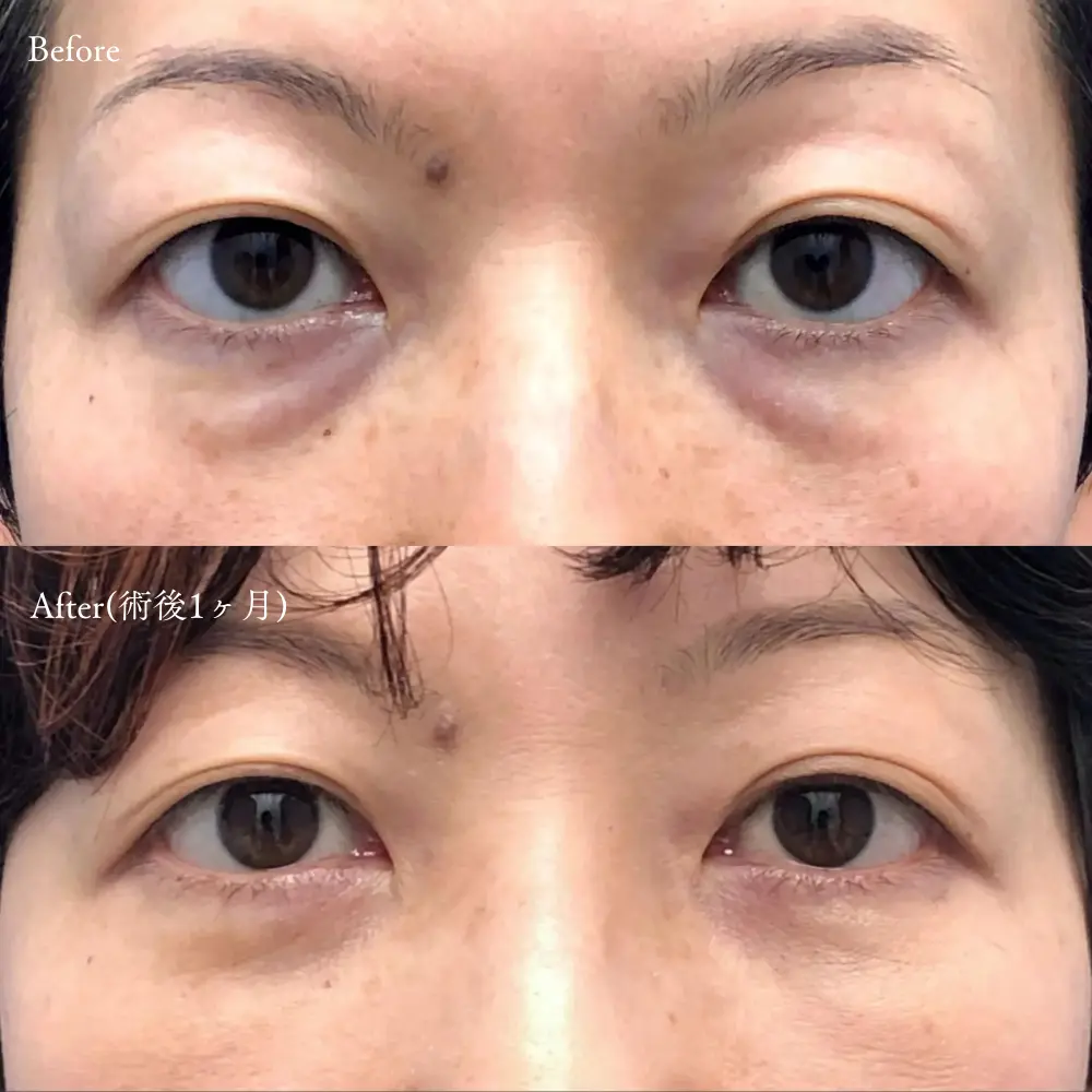 経結膜脱脂術の症例写真