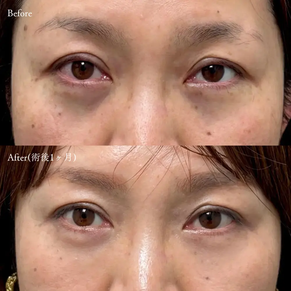 経結膜脱脂術とヒアルロン酸の症例写真