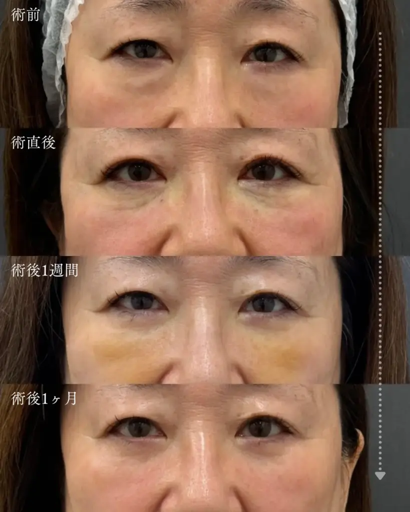 経結膜脱脂術のダウンタイム