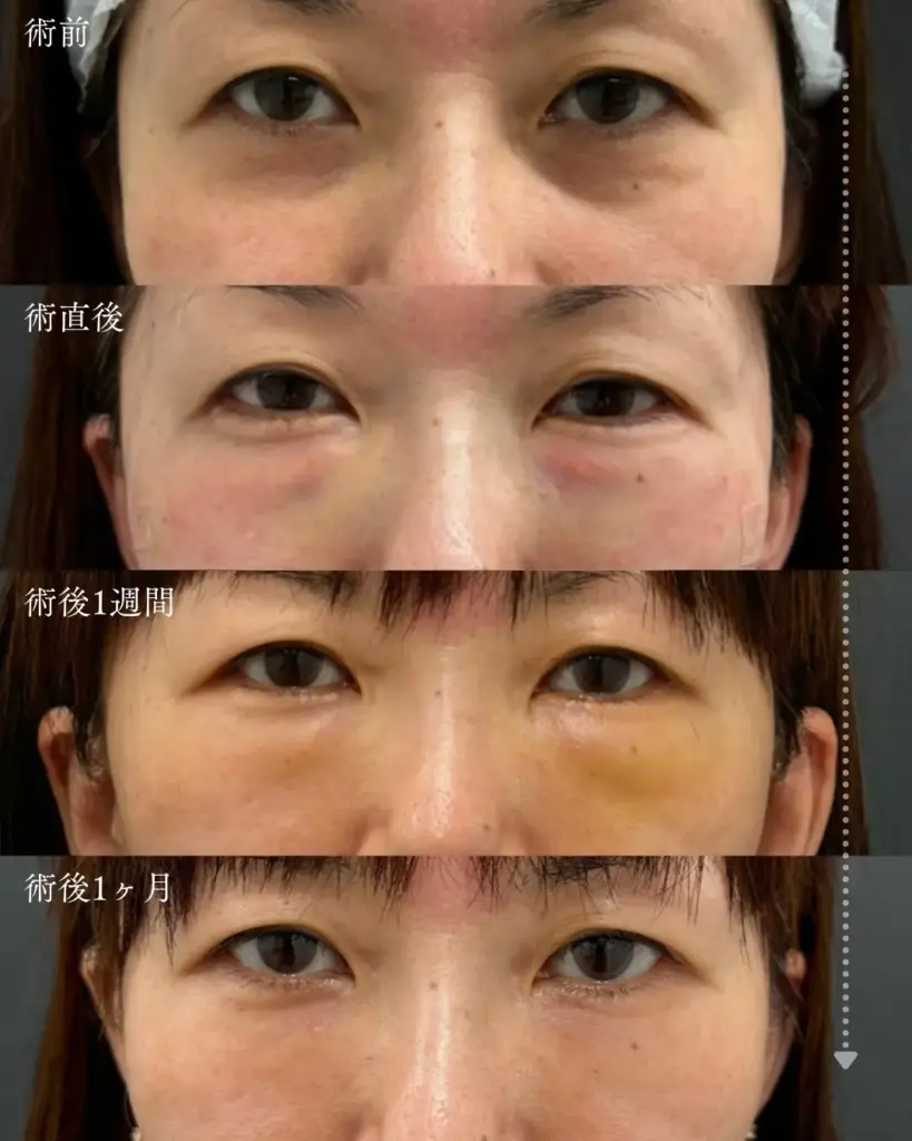 脂肪注入のダウンタイム