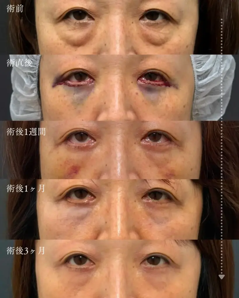 切開ハムラのダウンタイム