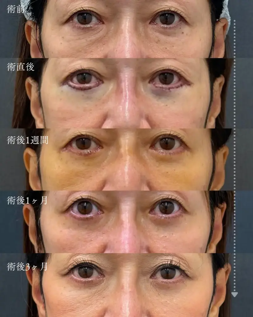 アイバックリムーブのダウンタイム