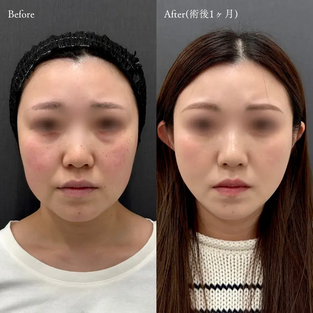 糸リフトの症例写真