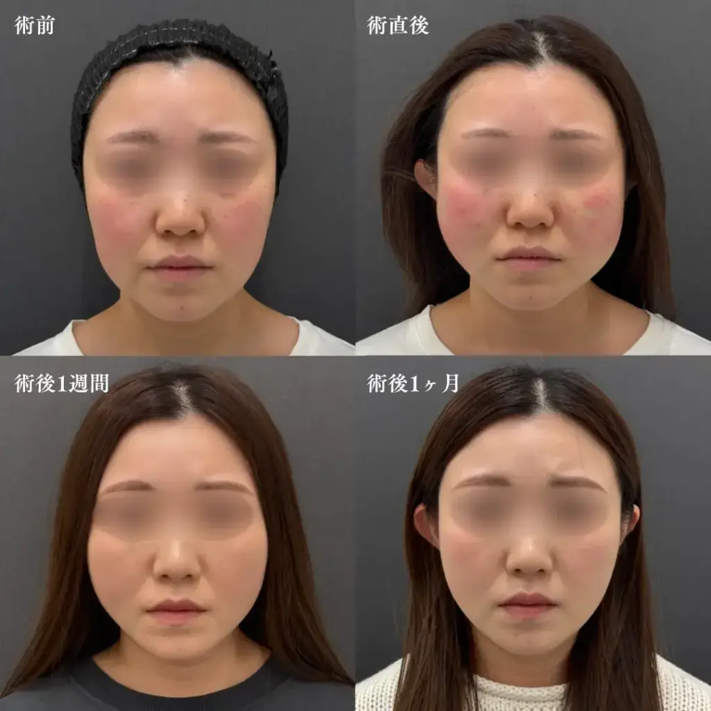 糸リフトのダウンタイム