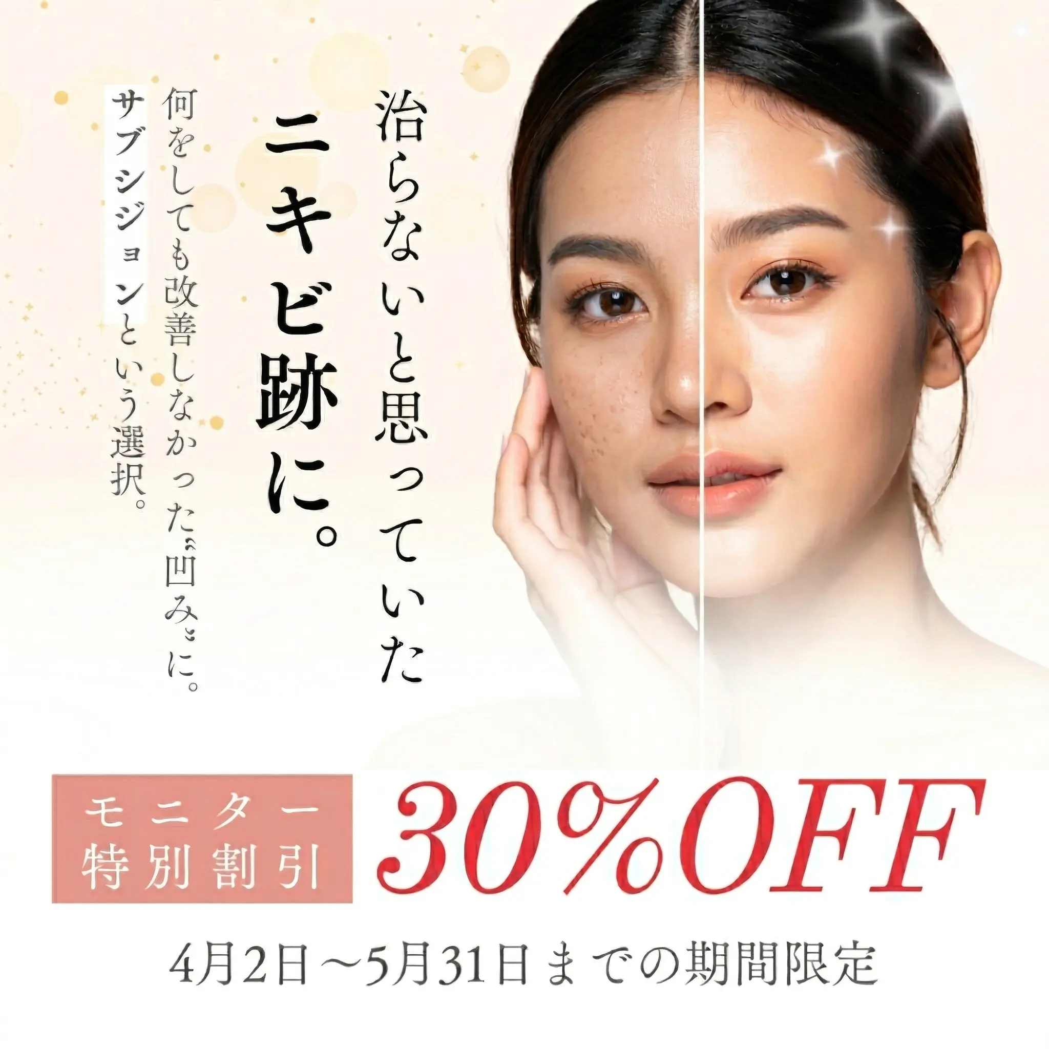 【特別キャンペーン】もう治らないと諦めていたニキビ跡に。サブシジョンという新しい選択。モニター30%OFFで美肌に！4月2日〜5月31日までの期間限定