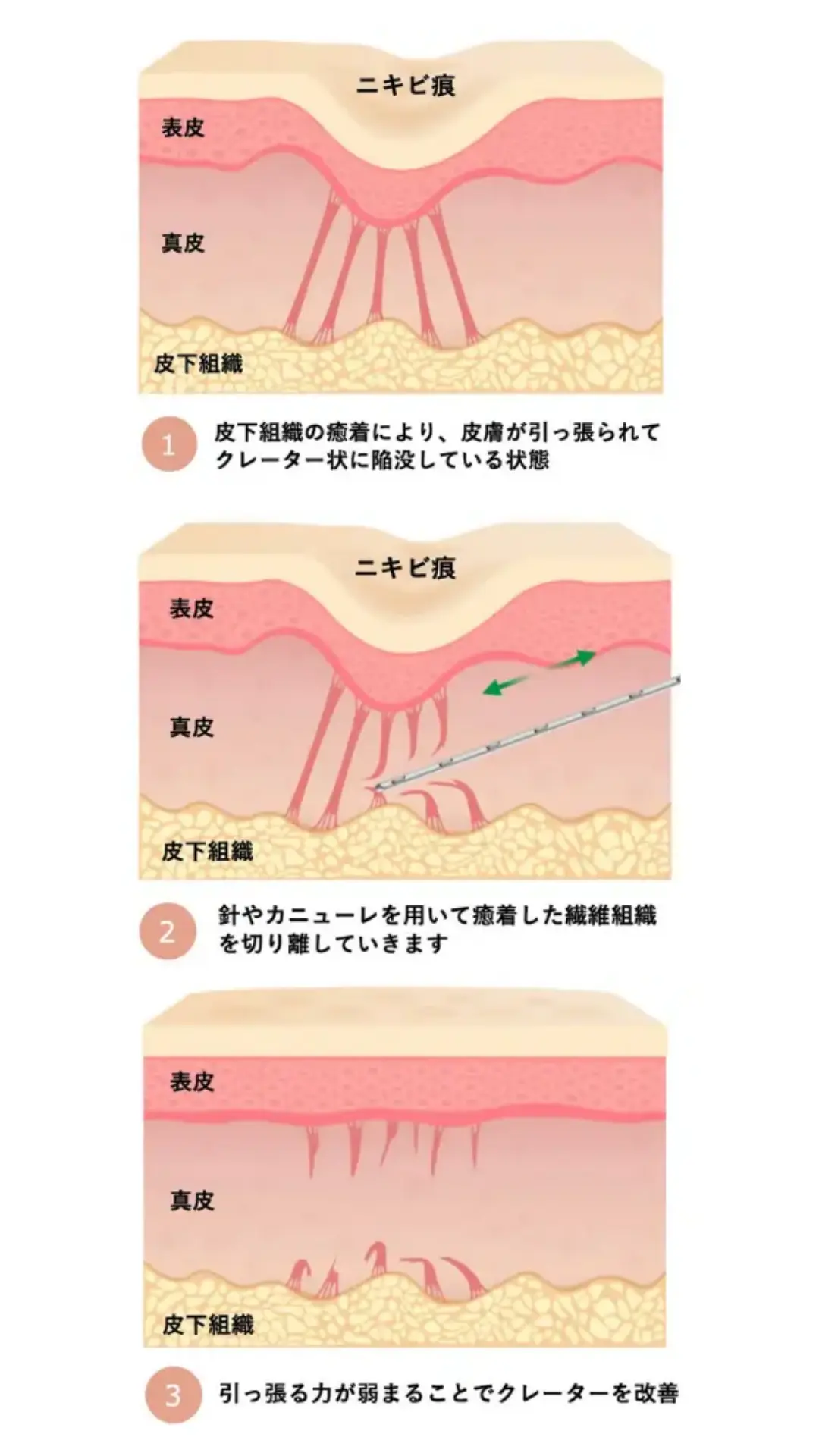 サブシジョンの仕組み図解
