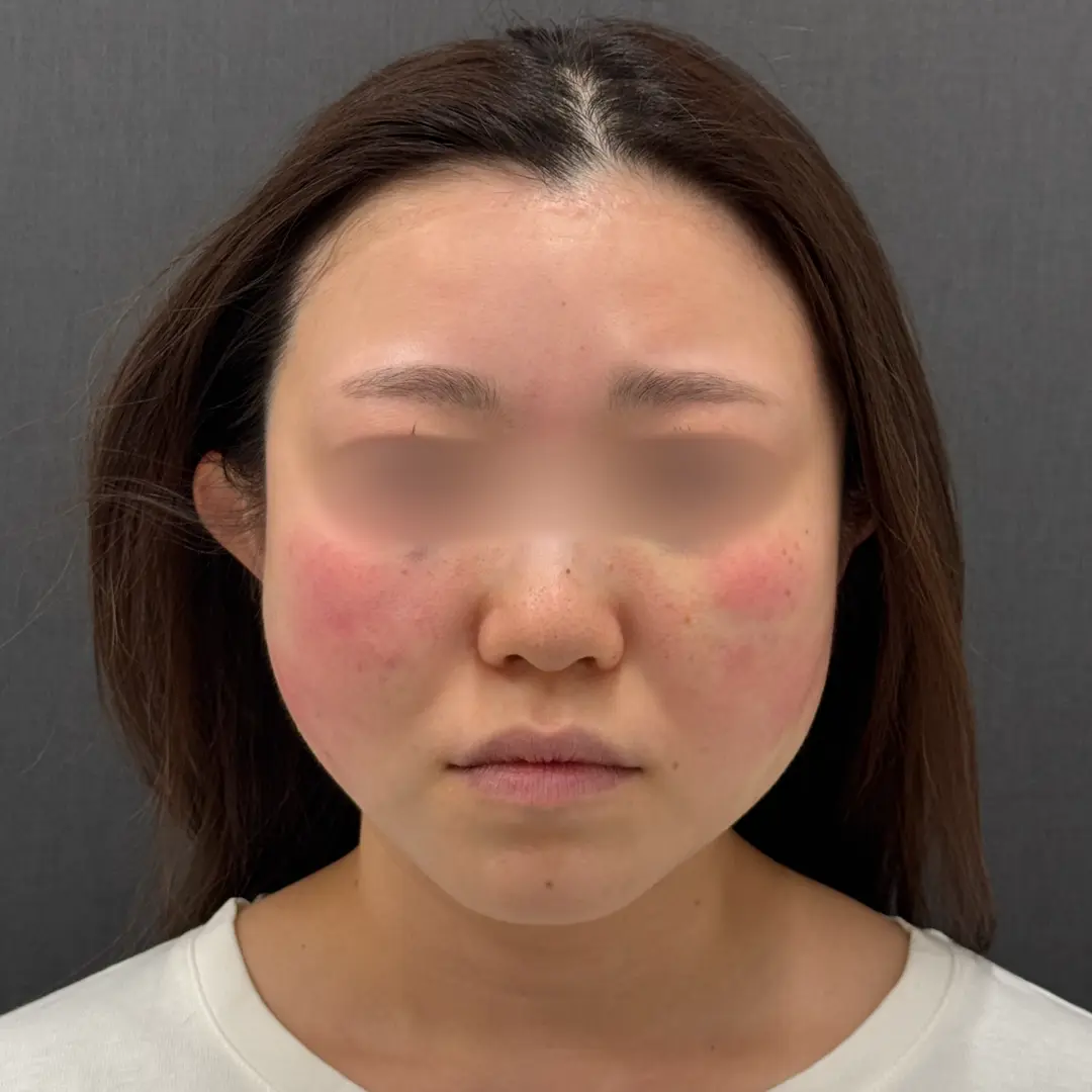 糸リフト 術直後