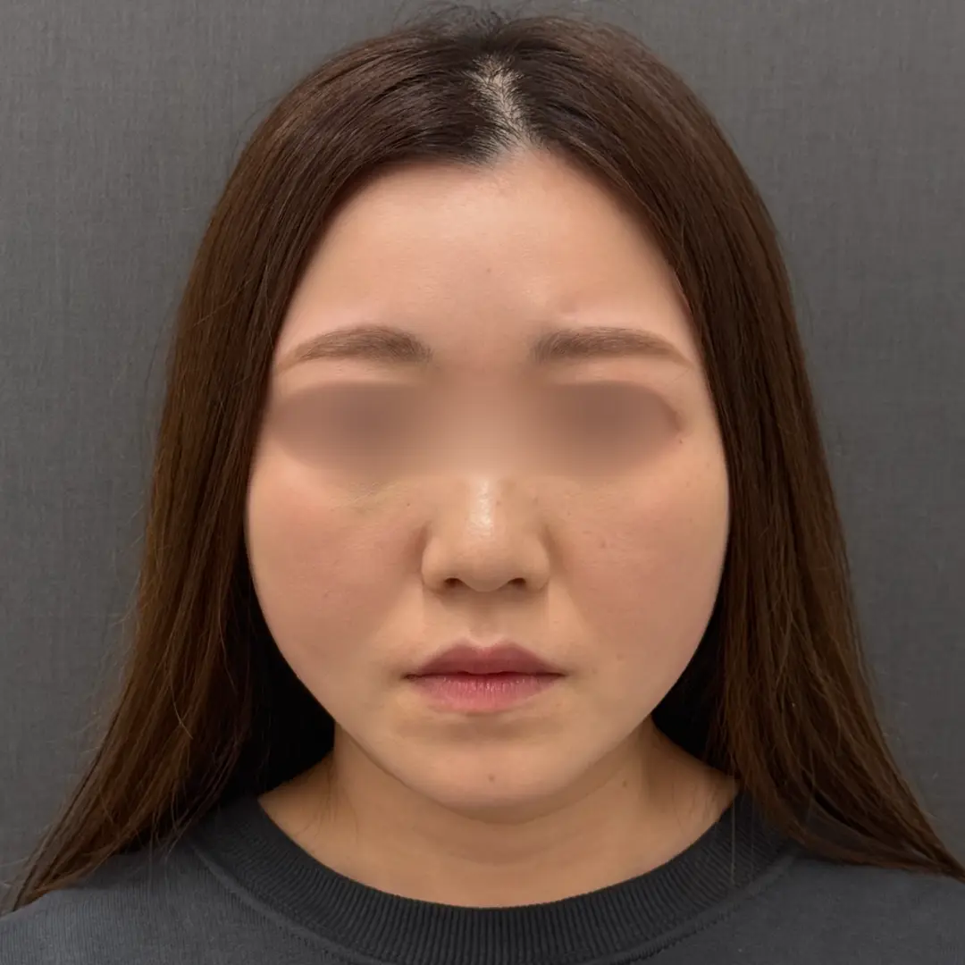 糸リフト 術後1週間