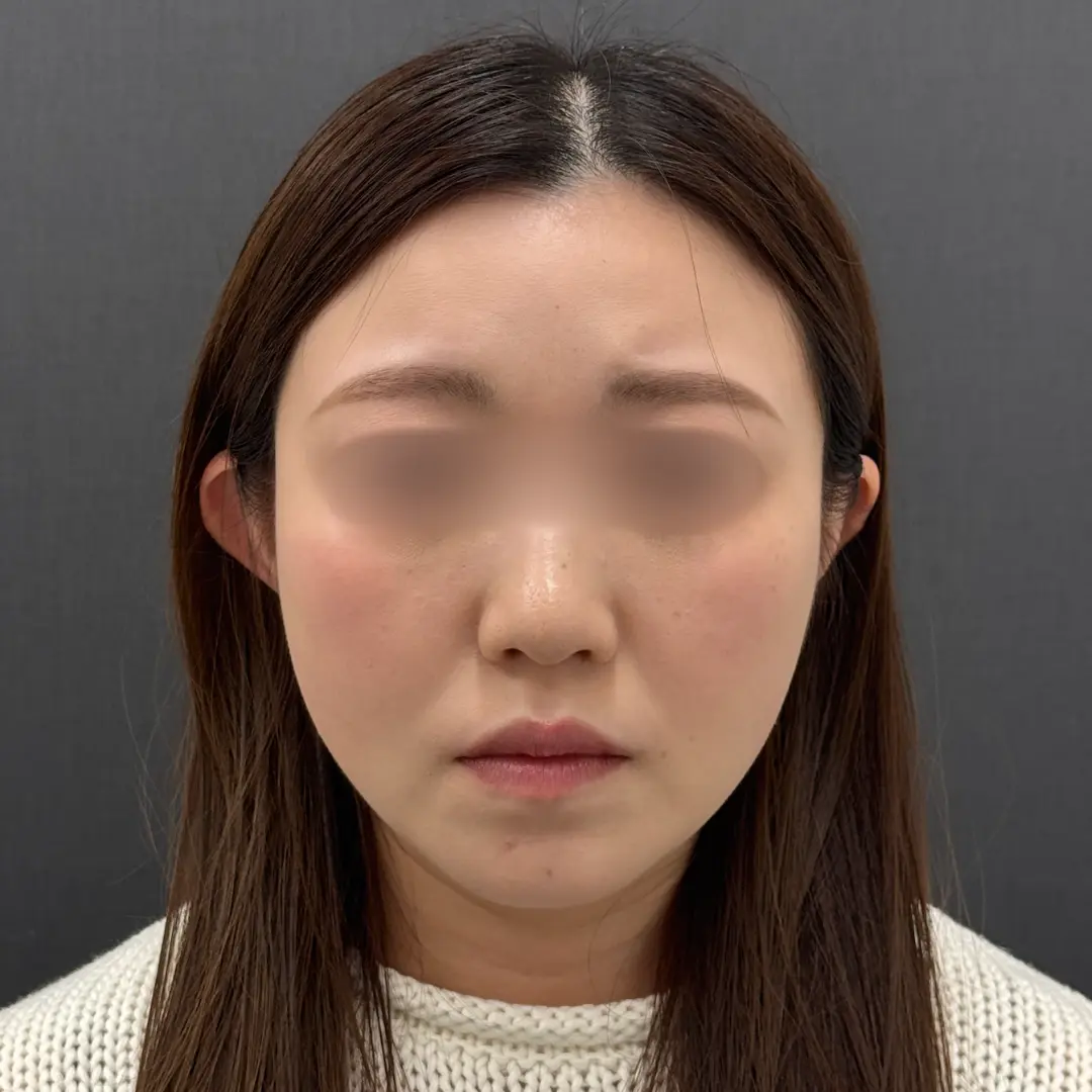 糸リフト 術後1ヶ月