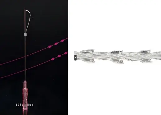 糸リフト 施術の様子