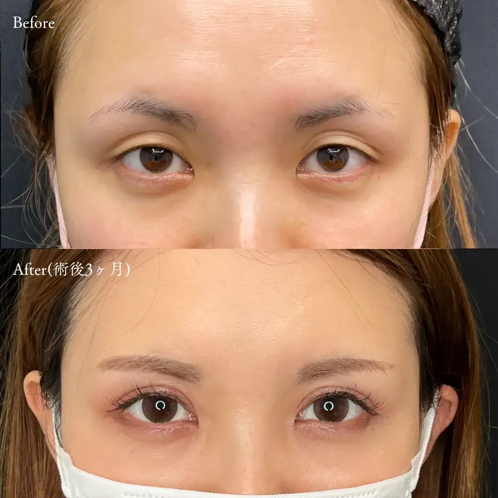 全切開二重 症例