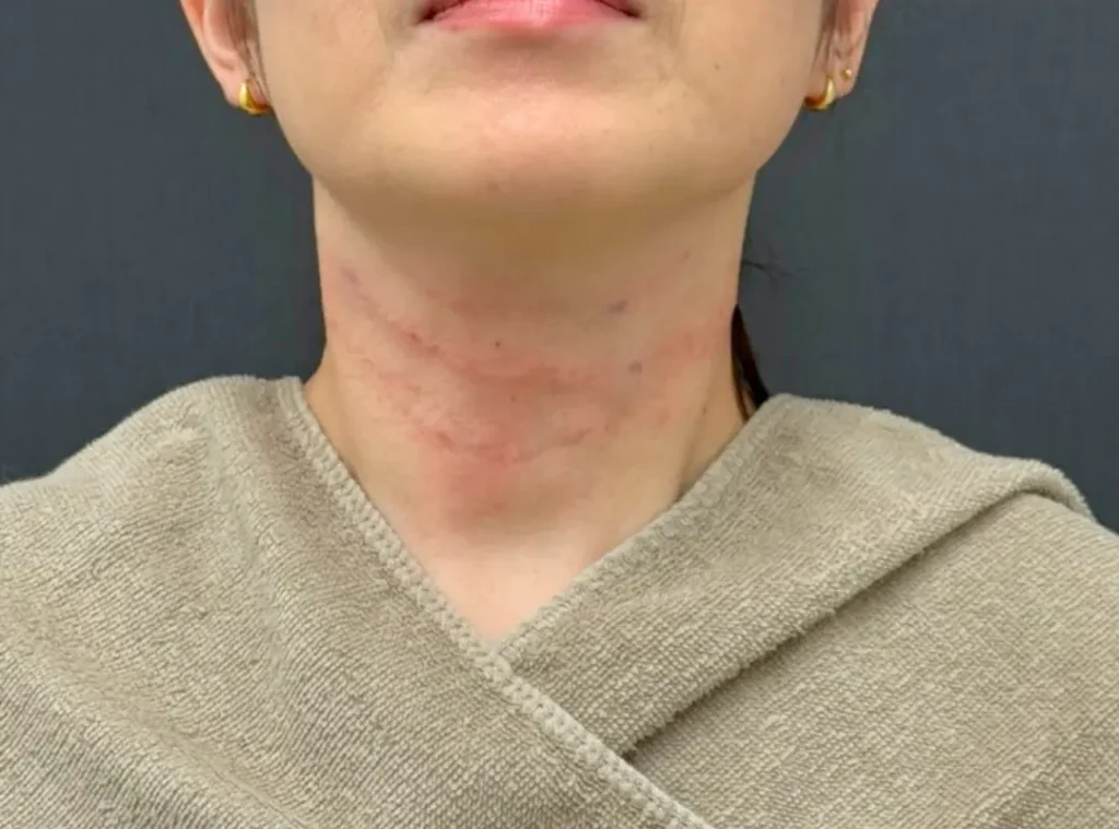 施術直後のボコつき（ダウンタイム）