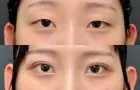 症例：二重埋没法 プレミアム法