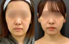 症例：アポロン式小顔脂肪吸引