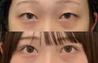 症例：アポロンアイズ法