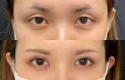 症例：全切開二重