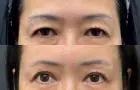 症例：眉下切開