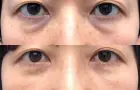 症例：経結膜脱脂術