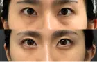 症例：裏ハムラ法