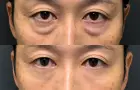 症例：切開ハムラ法