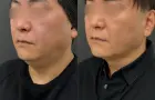 症例：頬・あご下脂肪吸引