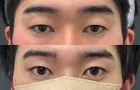 症例：眉下切開