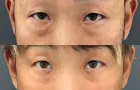 症例：裏ハムラ法