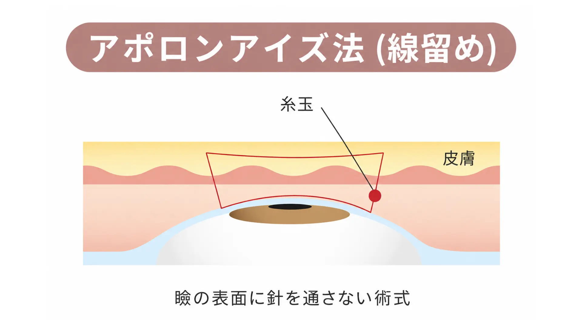 アポロンアイズ法 施術イメージ
