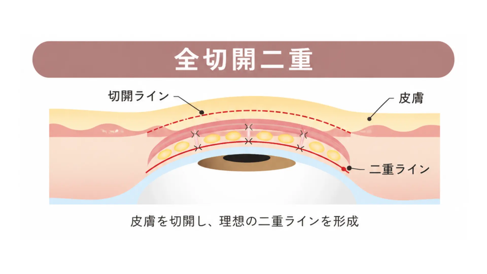 全切開二重 施術イメージ