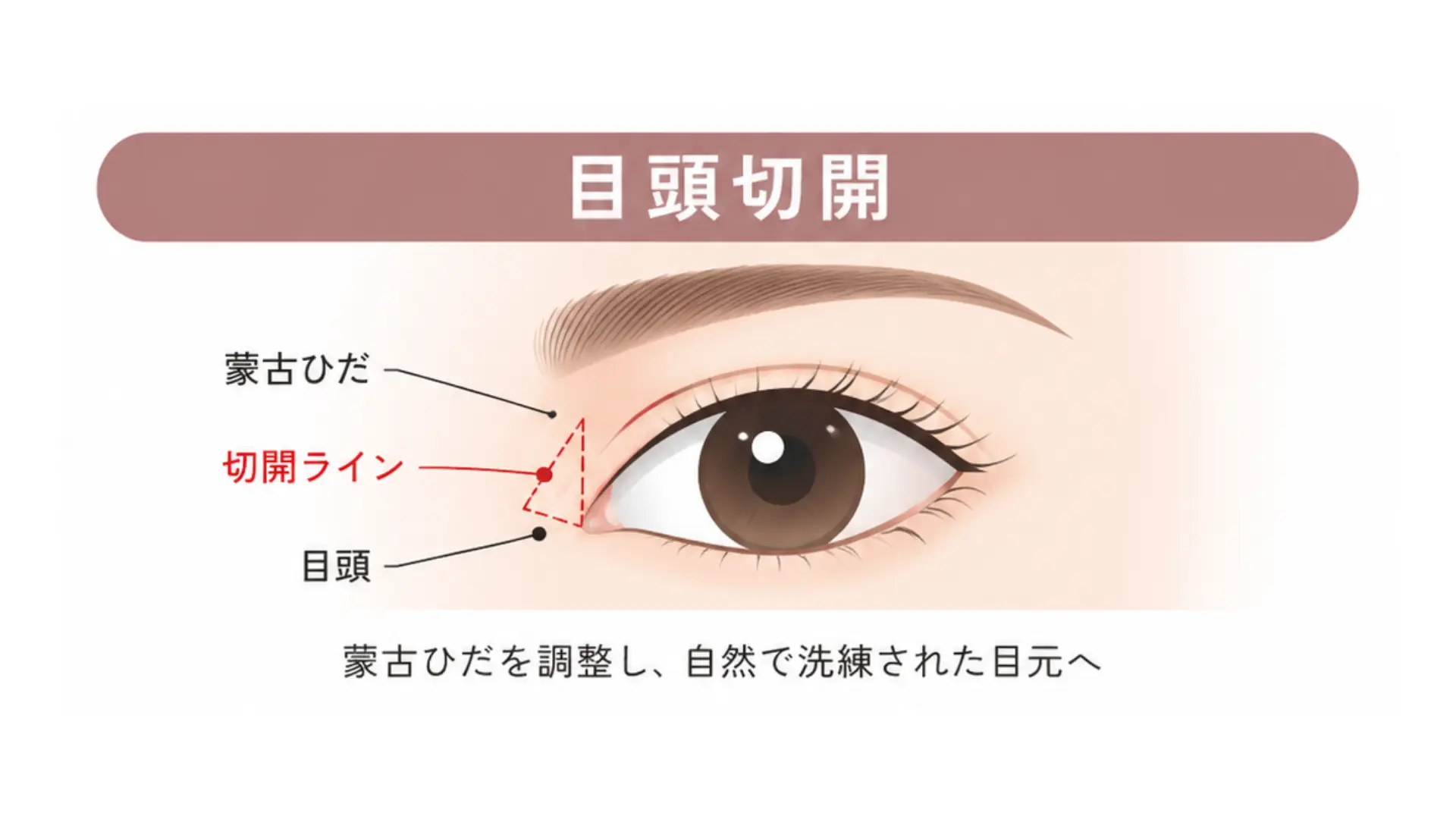 目頭切開 施術イメージ