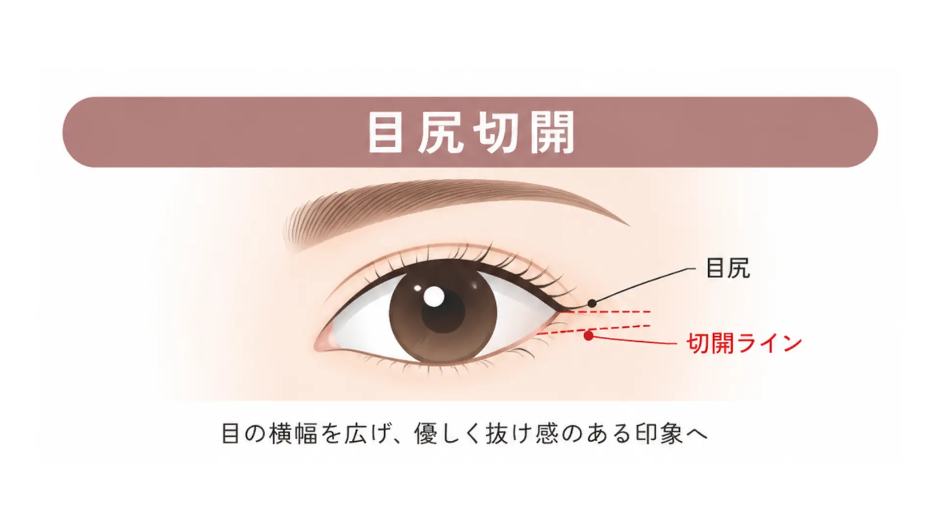 目尻切開 施術イメージ