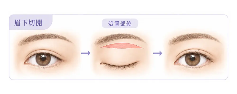 眉下切開のイメージ