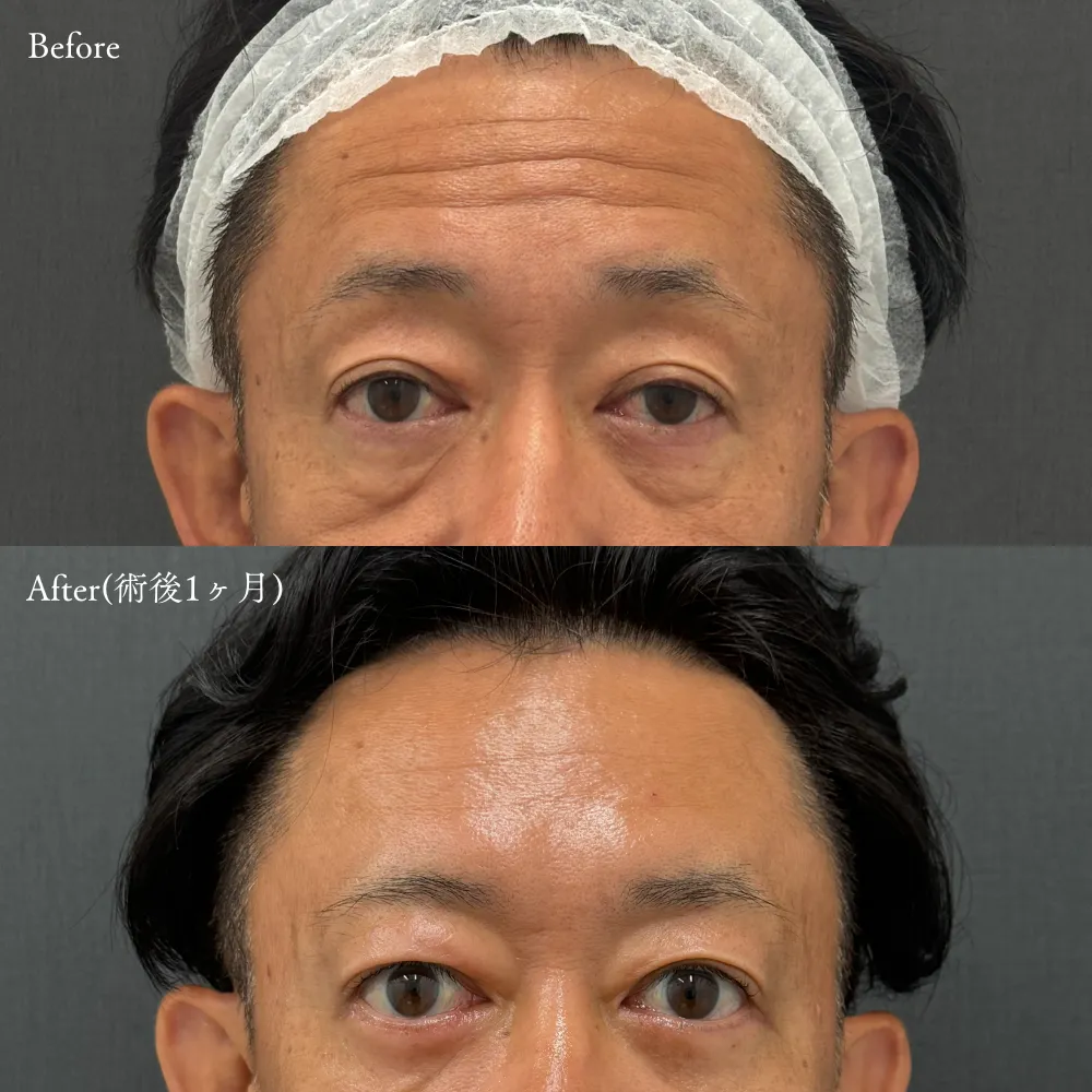 ボトックス注射（額・アラガン社製）の症例画像（40代・男性）