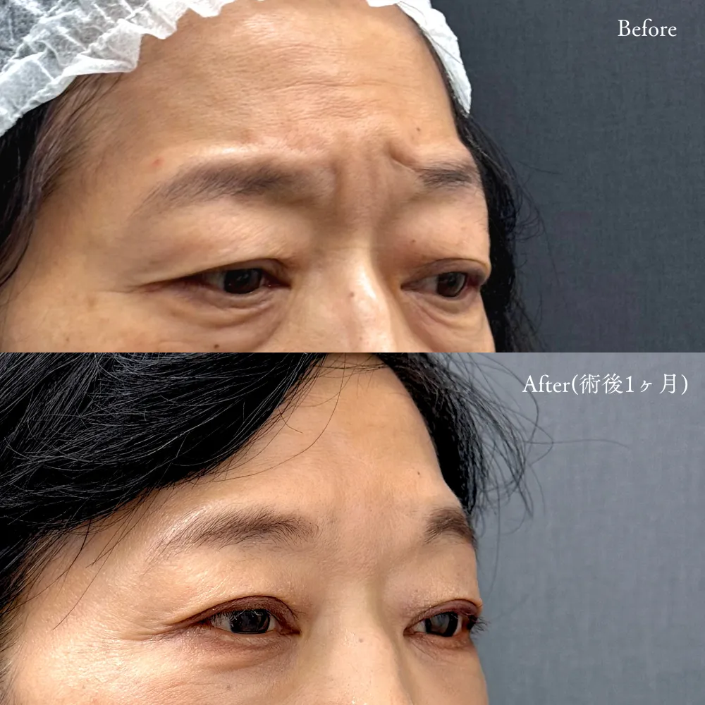 ボトックス注射（額・眉間）の症例画像（50代・女性）